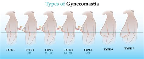 undeveloped tits|Tubular Breasts: What They Are, Causes & Treatment Options